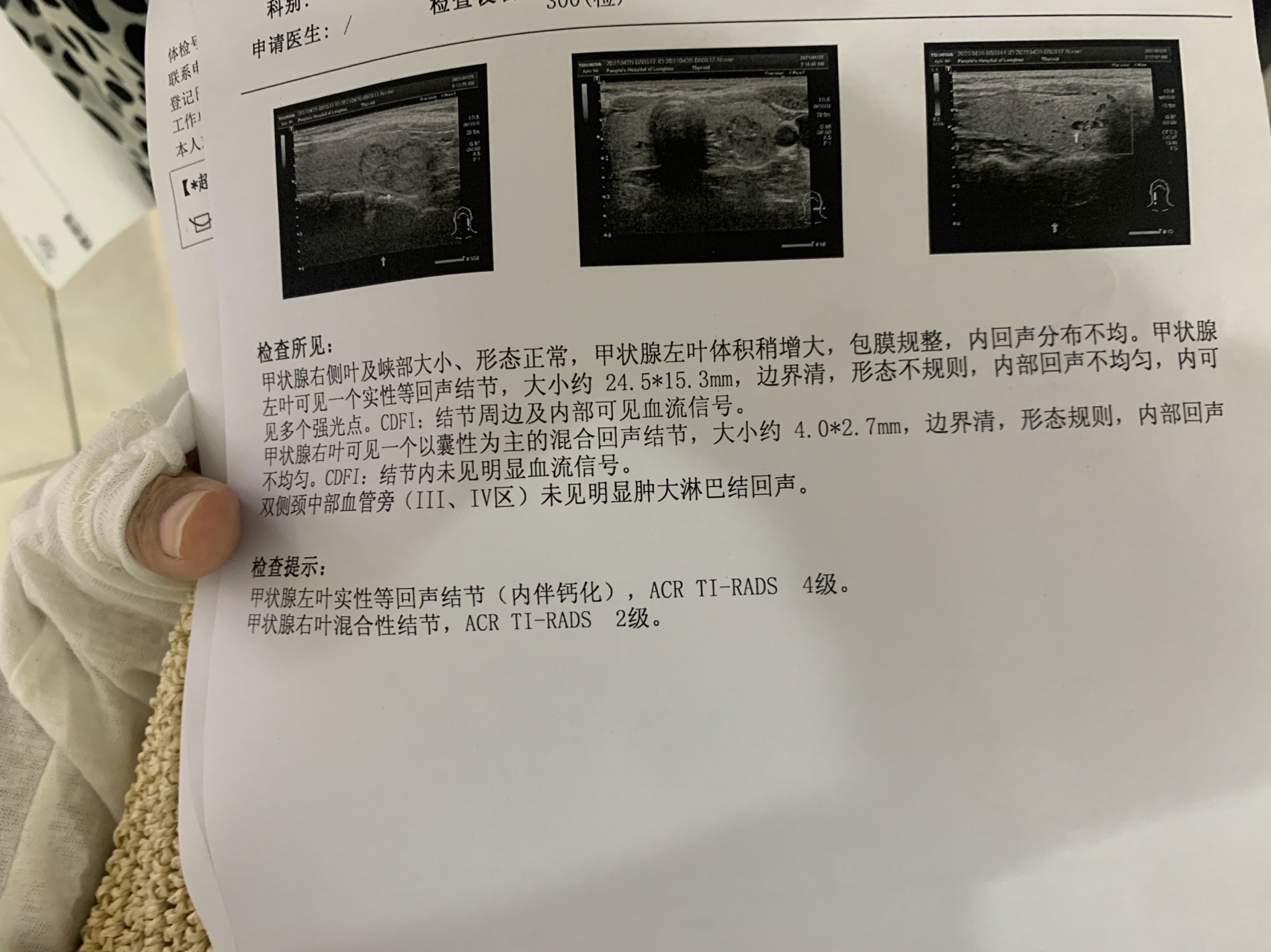 甲狀腺結(jié)節(jié)大小多少mm以上建議手術(shù)？全面解讀甲狀腺結(jié)節(jié)手術(shù)標(biāo)準(zhǔn)與注意事項(xiàng)，甲狀腺結(jié)節(jié)手術(shù)標(biāo)準(zhǔn)與注意事項(xiàng)，何時(shí)需手術(shù)？甲狀腺結(jié)節(jié)大小臨界點(diǎn)解析