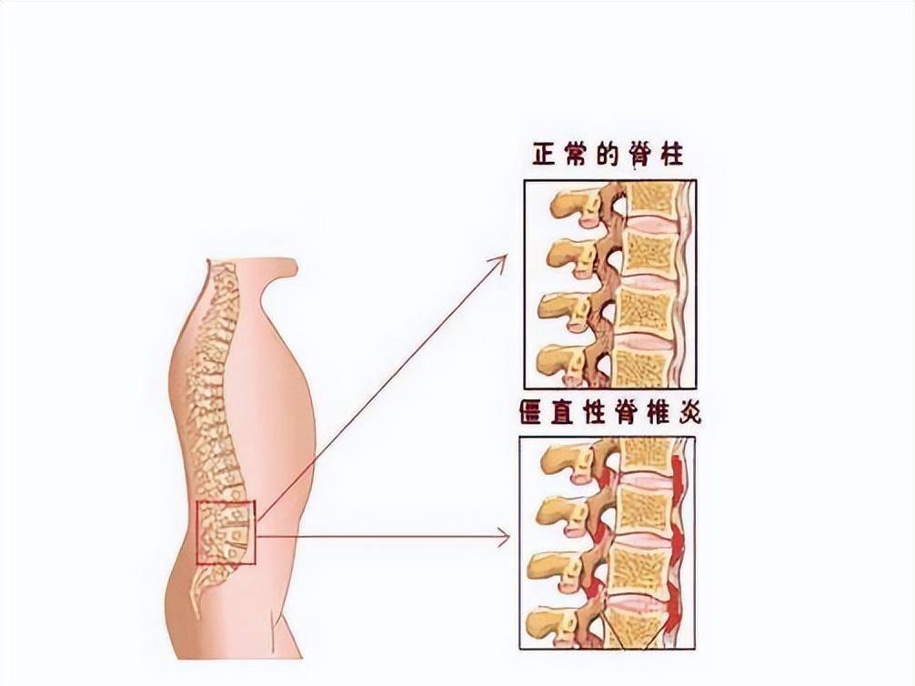 強(qiáng)直性脊柱炎能治愈嗎？——解析疾病與治療方法，強(qiáng)直性脊柱炎的治療方法及能否治愈解析