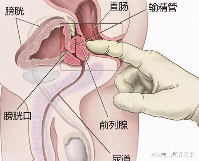 慢性前列腺炎的癥狀及其影響，深入了解與應對，慢性前列腺炎的癥狀、影響及應對之策詳解