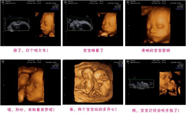 四維彩超怎么看男女，全方位解讀胎兒性別鑒定技術(shù)，四維彩超胎兒性別鑒定技術(shù)全方位解讀，如何準(zhǔn)確判斷男女？