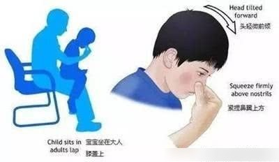 流鼻血的正確止血方法，流鼻血的正確止血方法詳解
