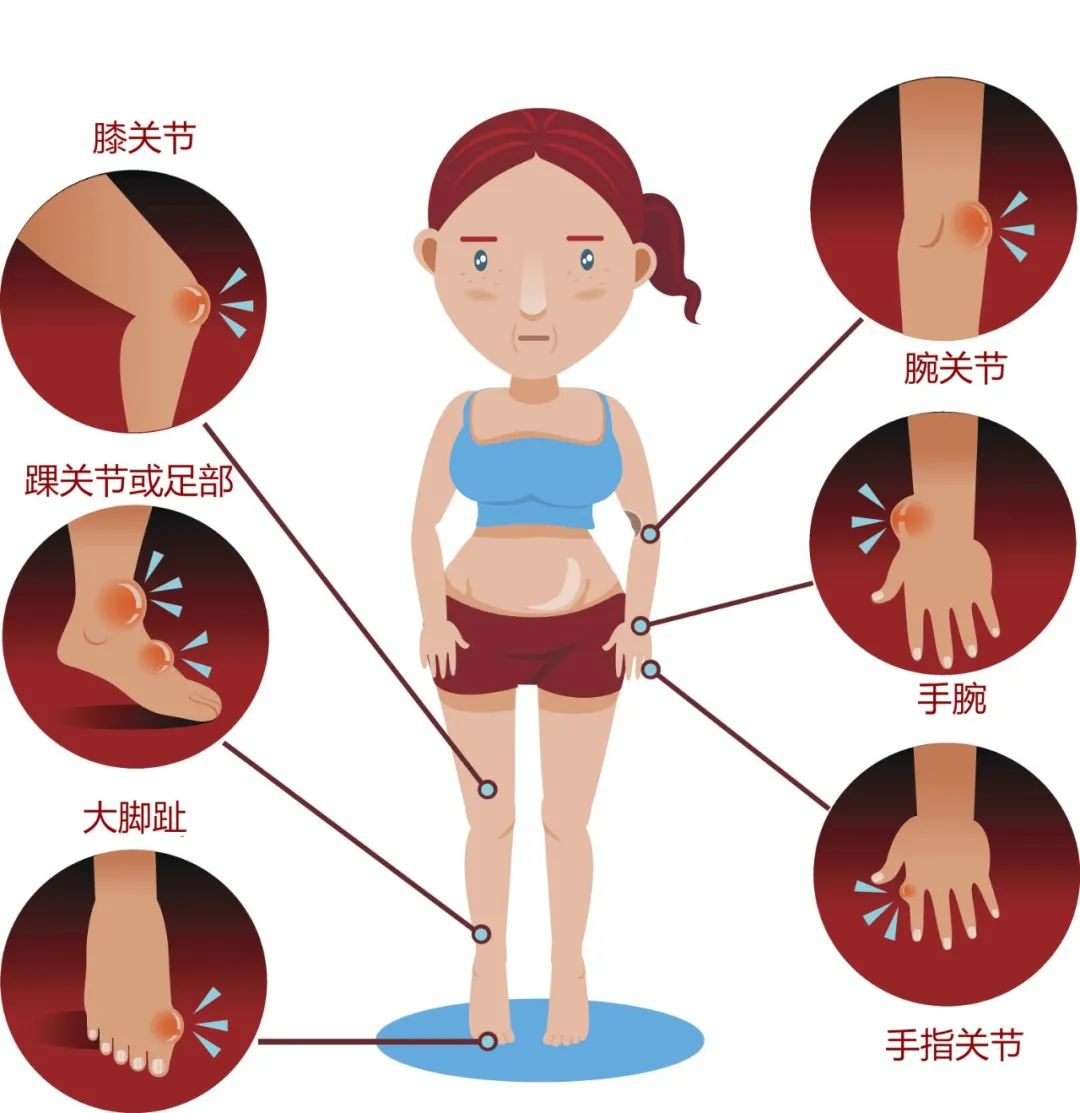 痛風(fēng)的幾個(gè)部位圖片及其相關(guān)知識(shí)解析，痛風(fēng)疼痛部位圖示及知識(shí)解析
