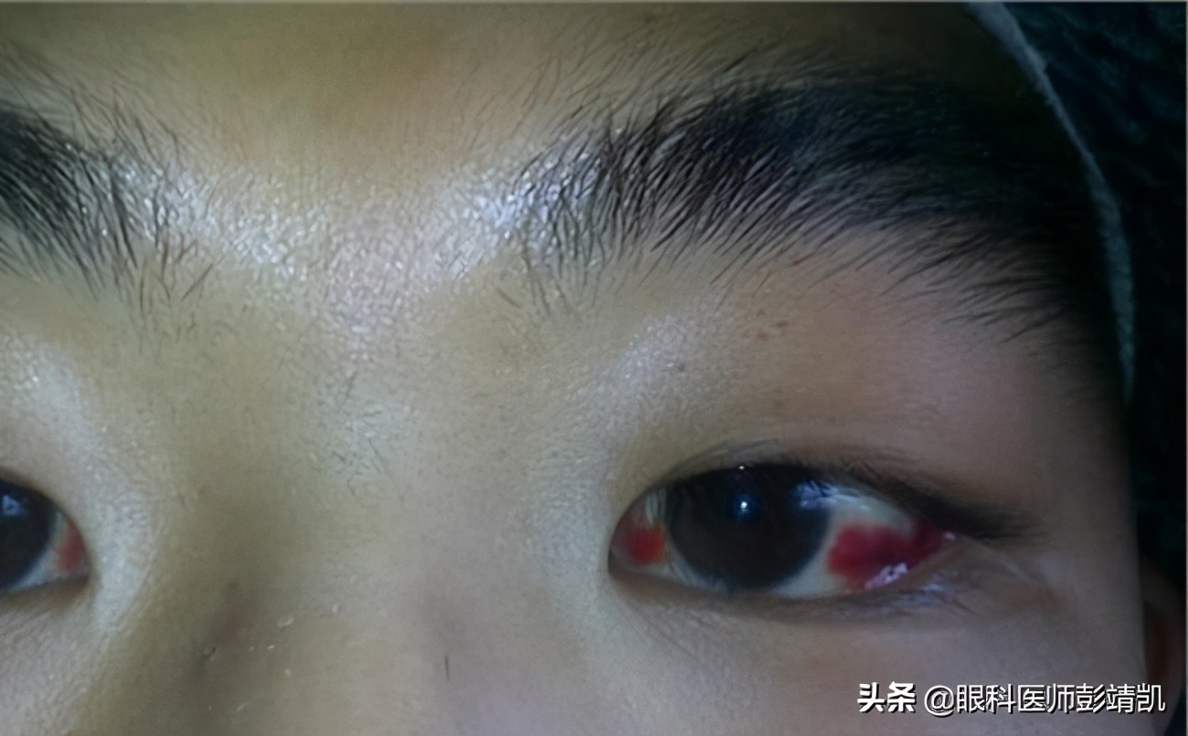 眼球發(fā)紅充血的原因及應(yīng)對(duì)措施，眼球發(fā)紅充血，原因解析與應(yīng)對(duì)策略