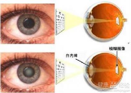 白內(nèi)障的早期癥狀及其識(shí)別，白內(nèi)障早期癥狀識(shí)別與預(yù)防