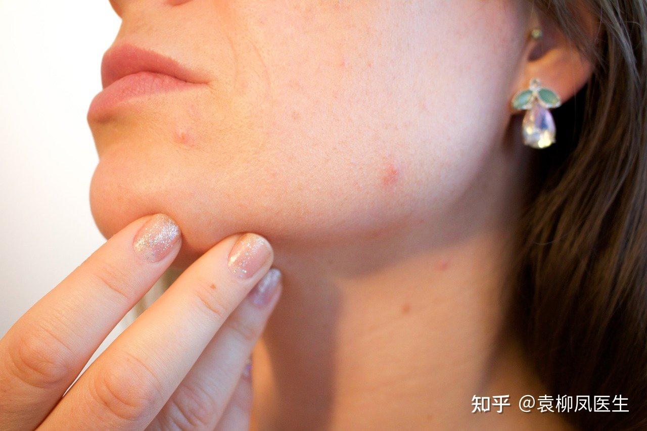 HPV痘痘長啥樣子？了解與預防的關鍵，HPV引發(fā)的痘痘特征及預防關鍵知識解讀